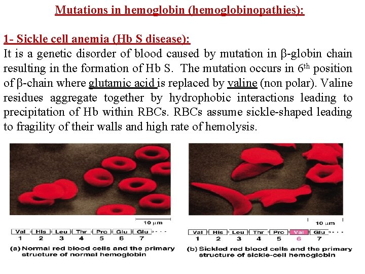 Mutations in hemoglobin (hemoglobinopathies): 1 - Sickle cell anemia (Hb S disease): It is