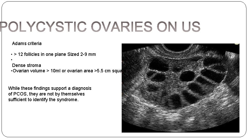 Adams criteria • > 12 follicles in one plane Sized 2 -9 mm •