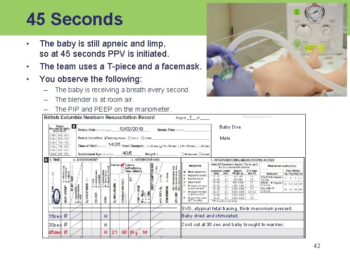 45 Seconds • • • The baby is still apneic and limp, so at