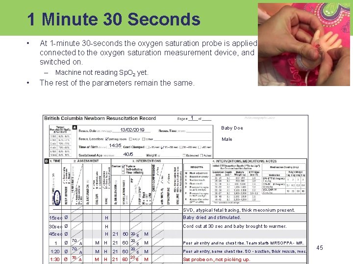 1 Minute 30 Seconds • At 1 -minute 30 -seconds the oxygen saturation probe