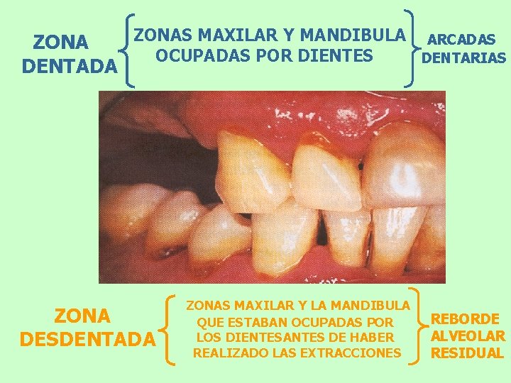 ZONAS MAXILAR Y MANDIBULA ZONA OCUPADAS POR DIENTES DENTADA ZONA DESDENTADA ZONAS MAXILAR Y