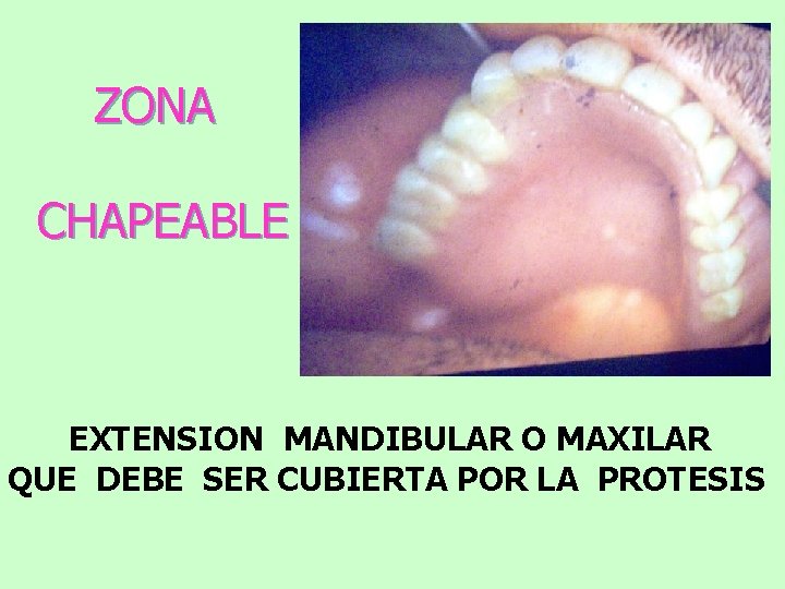 ZONA CHAPEABLE EXTENSION MANDIBULAR O MAXILAR QUE DEBE SER CUBIERTA POR LA PROTESIS 