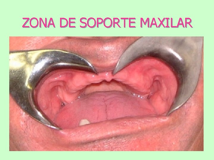 ZONA DE SOPORTE MAXILAR 