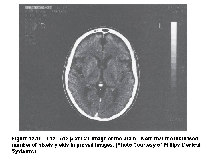 Figure 12. 15 512 ´ 512 pixel CT Image of the brain Note that the increased
