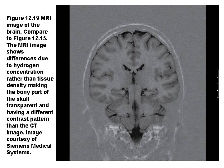 Figure 12. 19 MRI image of the brain. Compare to Figure 12. 15. The