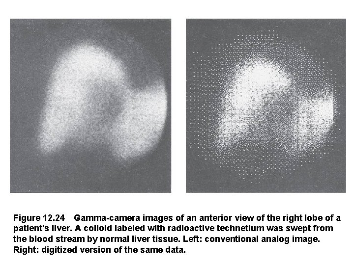 Figure 12. 24 Gamma-camera images of an anterior view of the right lobe of a