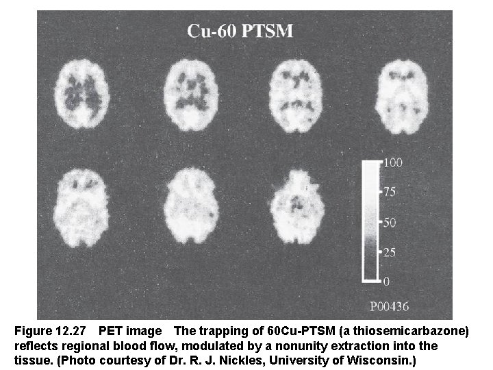 Figure 12. 27 PET image The trapping of 60 Cu-PTSM (a thiosemicarbazone) reflects regional blood flow,