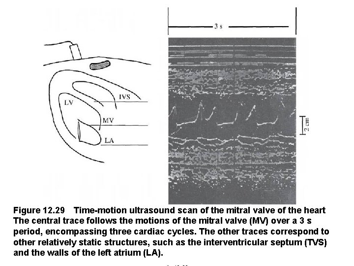 Figure 12. 29 Time-motion ultrasound scan of the mitral valve of the heart  The central