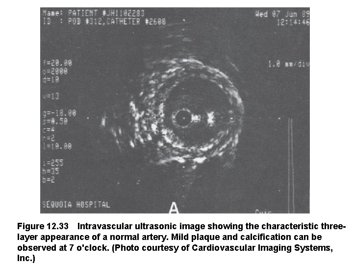 Figure 12. 33 Intravascular ultrasonic image showing the characteristic threelayer appearance of a normal artery.