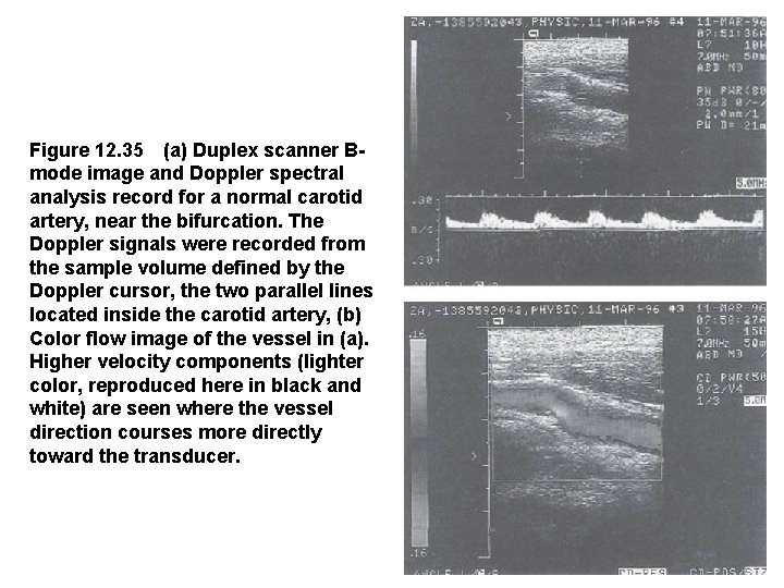Figure 12. 35 (a) Duplex scanner Bmode image and Doppler spectral analysis record for a