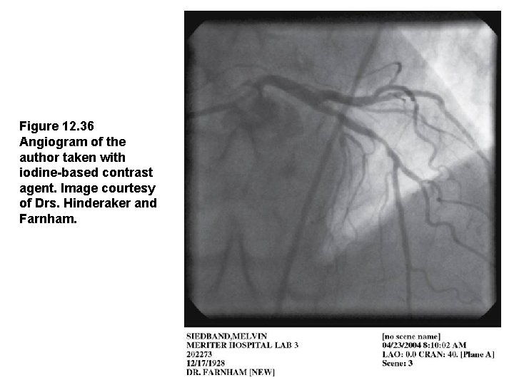 Figure 12. 36 Angiogram of the author taken with iodine-based contrast agent. Image courtesy