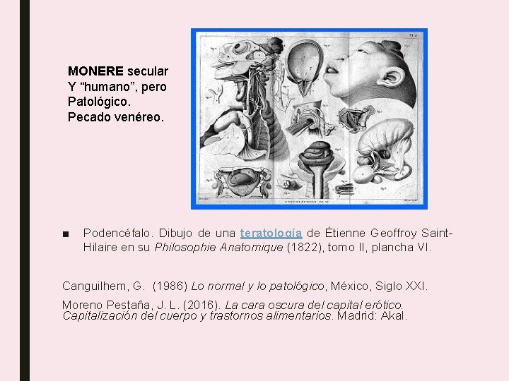 MONERE secular Y “humano”, pero Patológico. Pecado venéreo. ■ Podencéfalo. Dibujo de una teratología