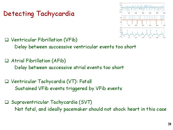 Detecting Tachycardia q Ventricular Fibrillation (VFib) Delay between successive ventricular events too short q