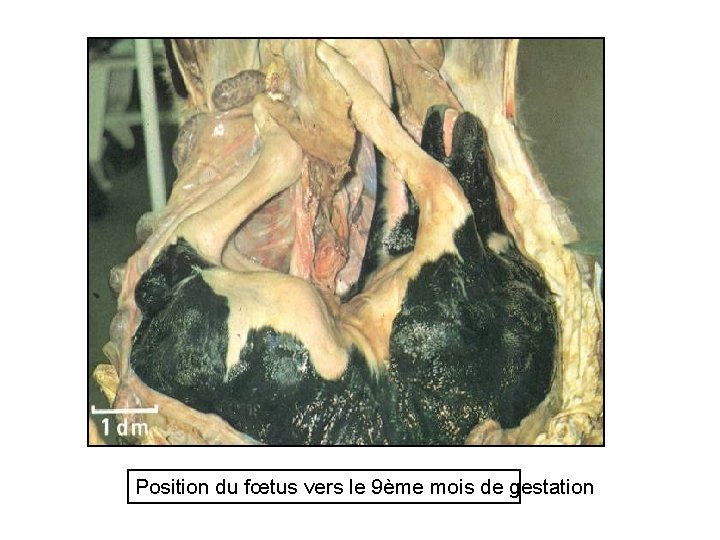 Position du fœtus vers le 9ème mois de gestation 34 