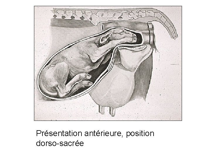 Présentation antérieure, position dorso-sacrée 60 