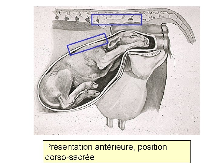 Présentation antérieure, position dorso-sacrée 65 