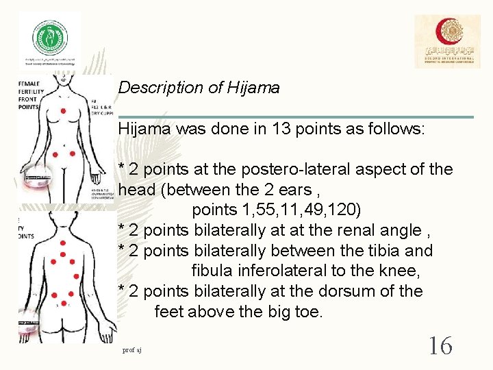 Description of Hijama was done in 13 points as follows: * 2 points at