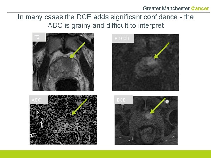 Greater Manchester Cancer In many cases the DCE adds significant confidence - the ADC