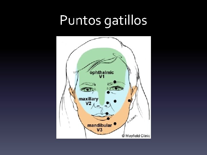 Puntos gatillos 