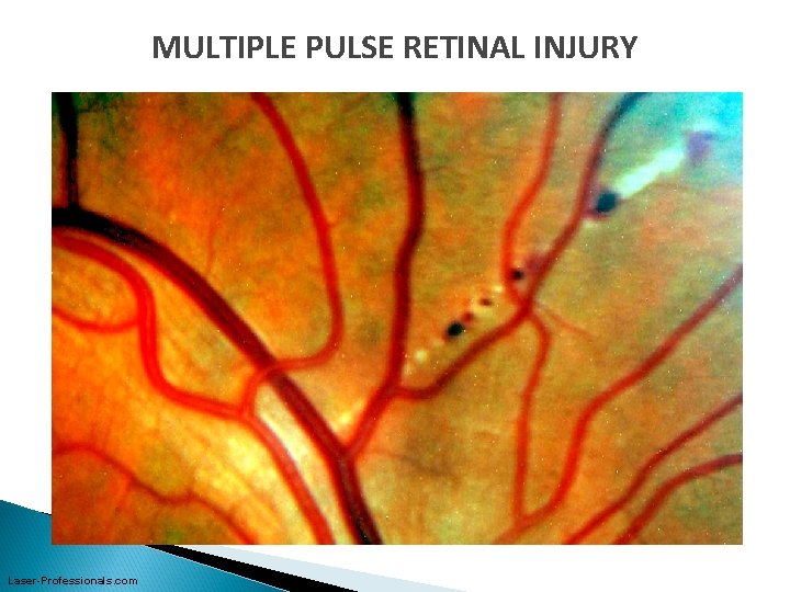 MULTIPLE PULSE RETINAL INJURY Laser-Professionals. com 