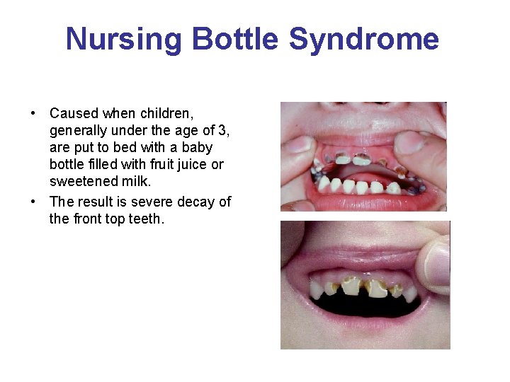 Nursing Bottle Syndrome • Caused when children, generally under the age of 3, are