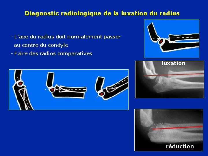 Diagnostic radiologique de la luxation du radius - L’axe du radius doit normalement passer