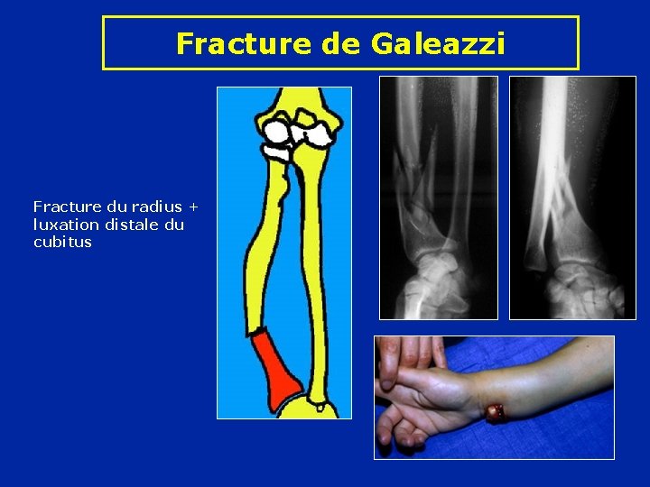 Fracture de Galeazzi Fracture du radius + luxation distale du cubitus 