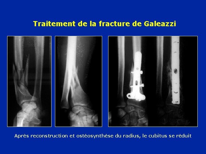 Traitement de la fracture de Galeazzi Après reconstruction et ostéosynthèse du radius, le cubitus
