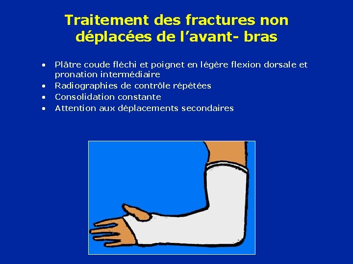 Traitement des fractures non déplacées de l’avant- bras • • Plâtre coude fléchi et