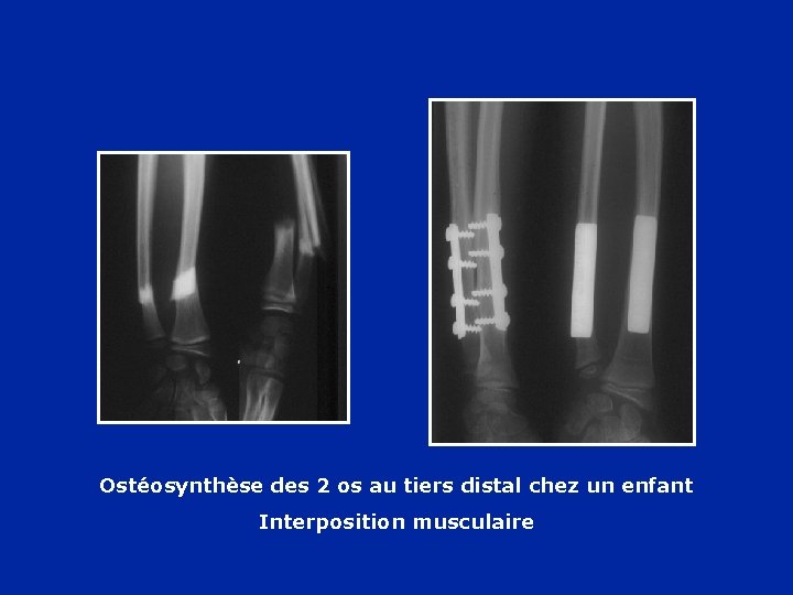 Ostéosynthèse des 2 os au tiers distal chez un enfant Interposition musculaire 
