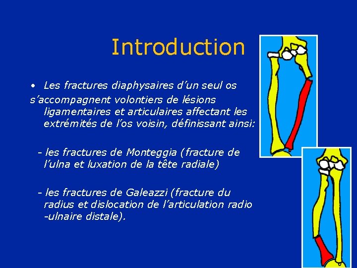 Introduction • Les fractures diaphysaires d’un seul os s’accompagnent volontiers de lésions ligamentaires et