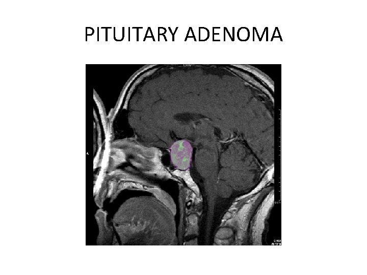 PITUITARY ADENOMA 