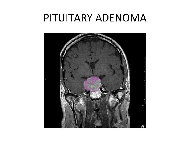 PITUITARY ADENOMA 