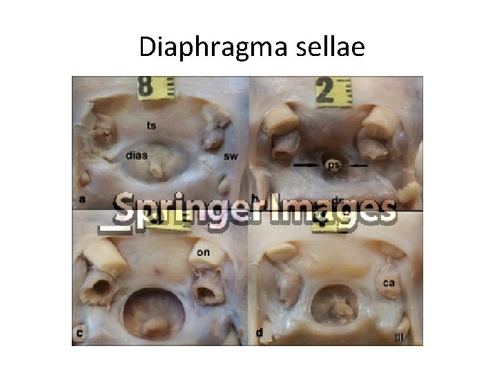 Diaphragma sellae 