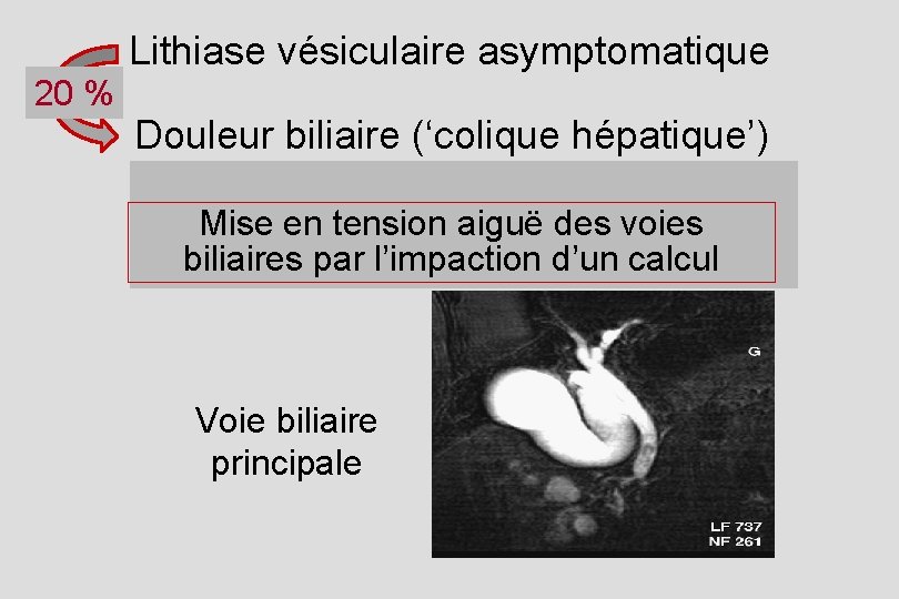 Lithiase vésiculaire asymptomatique 20 % Douleur biliaire (‘colique hépatique’) Mise en tension aiguë des