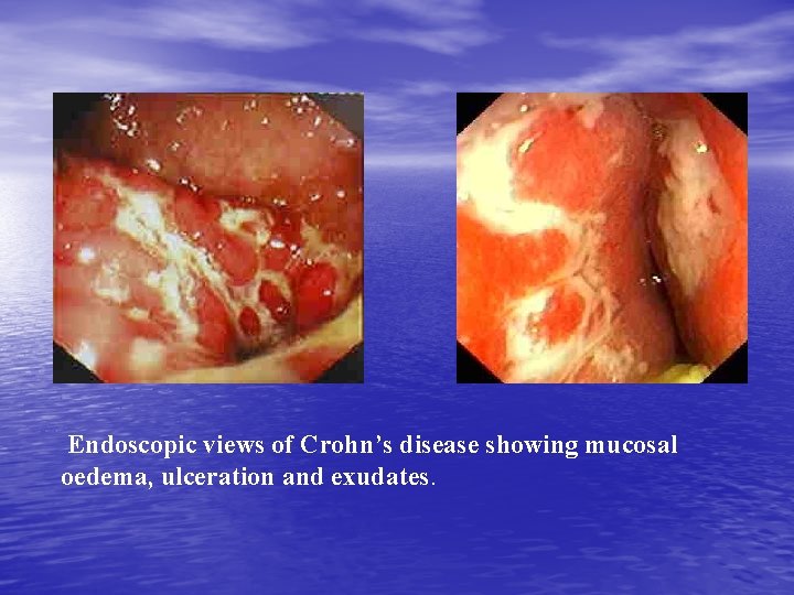 Endoscopic views of Crohn’s disease showing mucosal oedema, ulceration and exudates. 