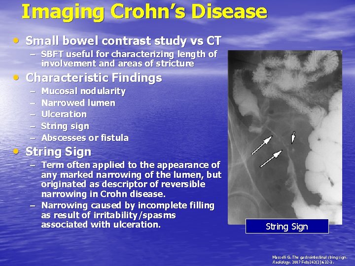 Imaging Crohn’s Disease • Small bowel contrast study vs CT – SBFT useful for