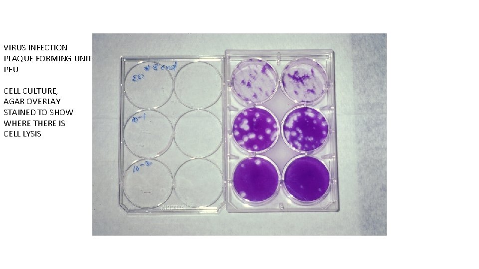 VIRUS INFECTION PLAQUE FORMING UNIT PFU CELL CULTURE, AGAR OVERLAY STAINED TO SHOW WHERE