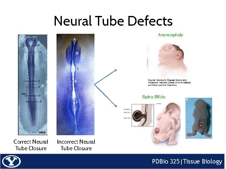 Neural Tube Defects Correct Neural Tube Closure Incorrect Neural Tube Closure 