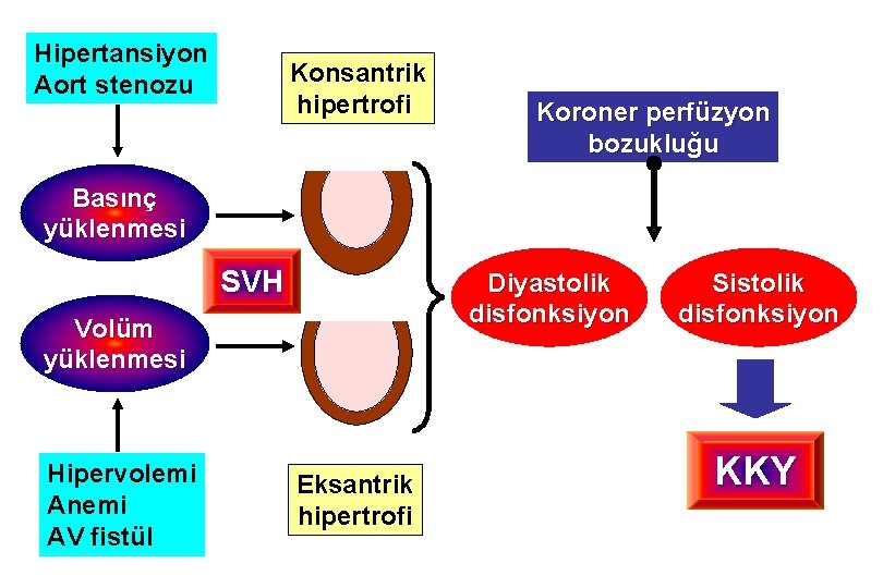 Hipertansiyon Aort stenozu Konsantrik hipertrofi Koroner perfüzyon bozukluğu Basınç yüklenmesi SVH Diyastolik disfonksiyon Volüm