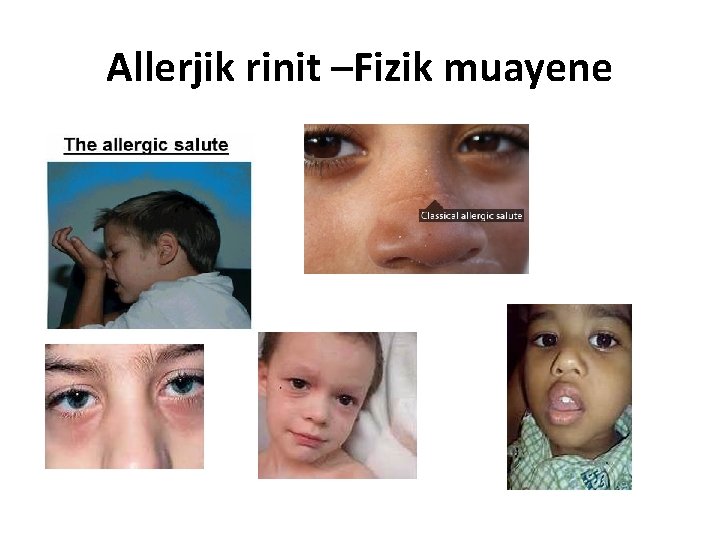 Allerjik rinit –Fizik muayene 