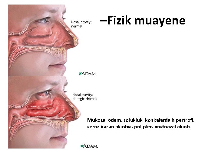 Allerjik rinit –Fizik muayene Mukozal ödem, solukluk, konkalarda hipertrofi, seröz burun akıntısı, polipler, postnazal