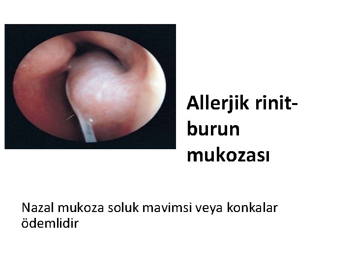 Allerjik rinitburun mukozası Nazal mukoza soluk mavimsi veya konkalar ödemlidir 