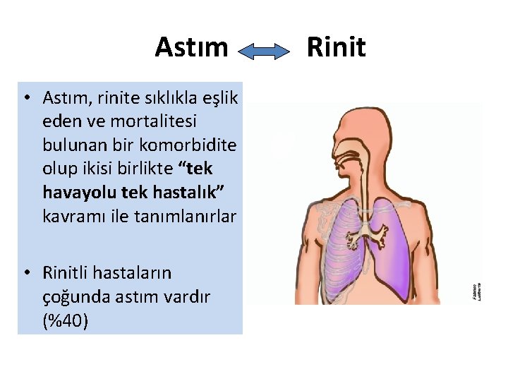 Astım • Astım, rinite sıklıkla eşlik eden ve mortalitesi bulunan bir komorbidite olup ikisi