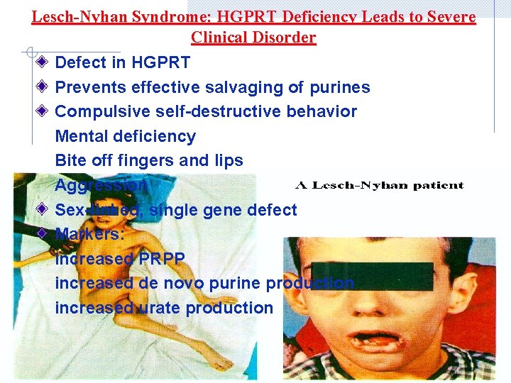 Lesch-Nyhan Syndrome: HGPRT Deficiency Leads to Severe Clinical Disorder Defect in HGPRT Prevents effective