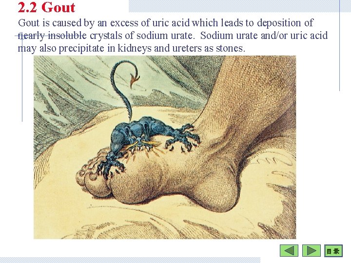 2. 2 Gout is caused by an excess of uric acid which leads to
