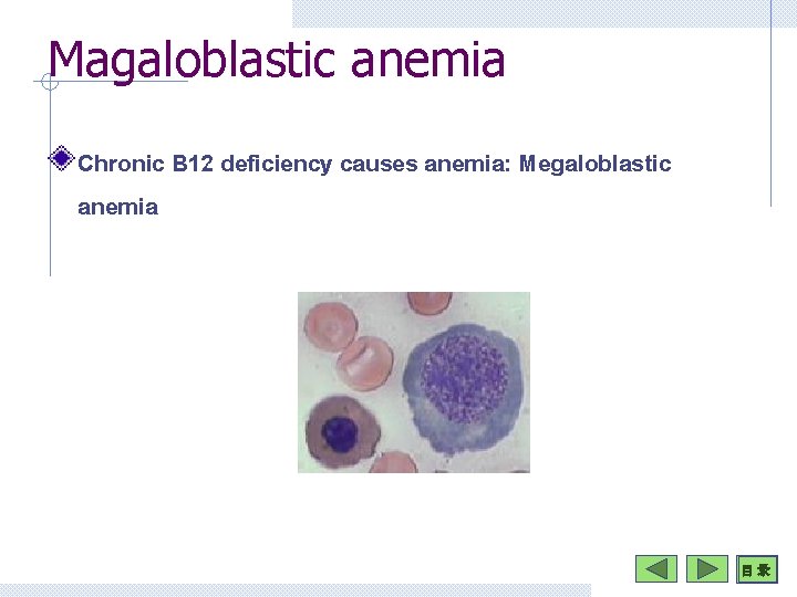 Magaloblastic anemia Chronic B 12 deficiency causes anemia: Megaloblastic anemia 目 录 