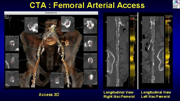 CTA : Femoral Arterial Access 3 D Longitudinal View Right Iliac/Femoral Longitudinal View Left CTA : Femoral Arterial Access 3 D Longitudinal View Right Iliac/Femoral Longitudinal View Left