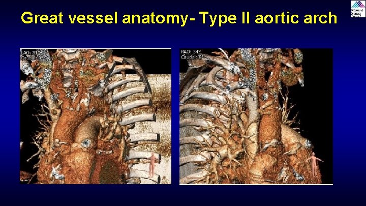 Great vessel anatomy- Type II aortic arch Great vessel anatomy- Type II aortic arch