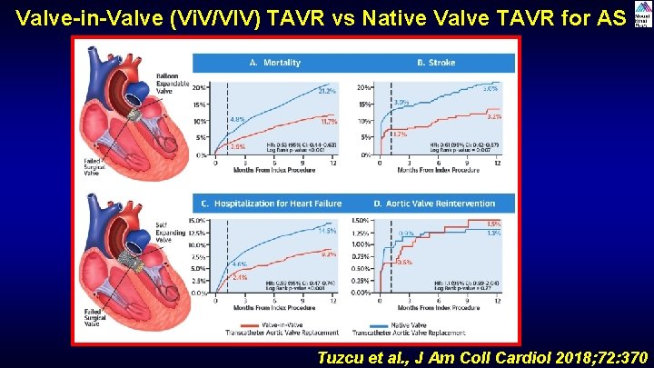 Valve-in-Valve (Vi. V/VIV) TAVR vs Native Valve TAVR for AS Tuzcu et al. , Valve-in-Valve (Vi. V/VIV) TAVR vs Native Valve TAVR for AS Tuzcu et al. ,